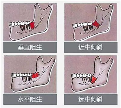 四类智齿请及时拔除