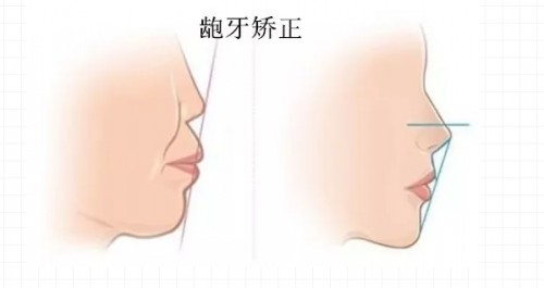 杭州丽贝口腔诊:牙齿矫正效果最佳的是这4类人群,你在其中吗? 