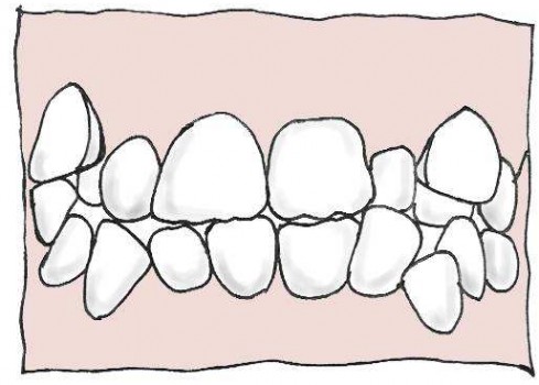 杭州丽贝口腔诊:牙齿矫正效果最佳的是这4类人群,你在其中吗? 