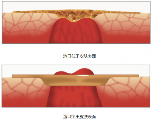 造口护理：为什么要使用凸面底盘？