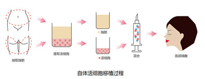 自体脂肪移植