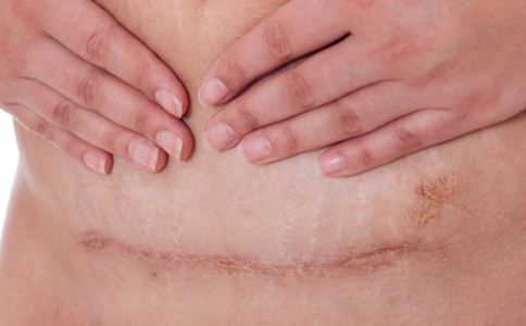 剖腹产后疤痕怎么淡化 淡化疤痕的方法 产后疤痕怎么淡化
