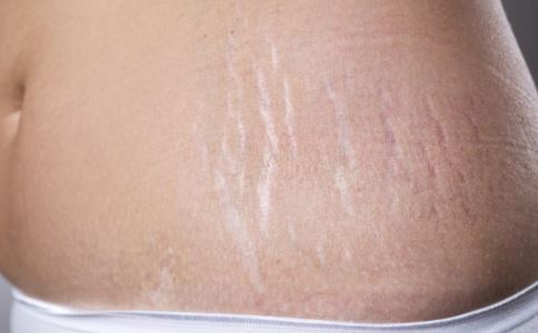怎样去妊娠纹小窍门 妊娠纹怎样能消除 妊娠纹怎么预防
