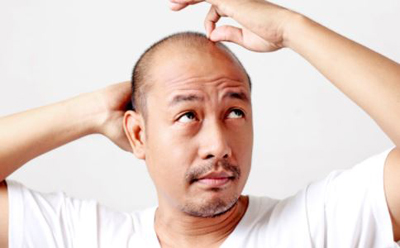 男性脱发是什么原因 男性脱发怎么办 男性脱发如何治疗